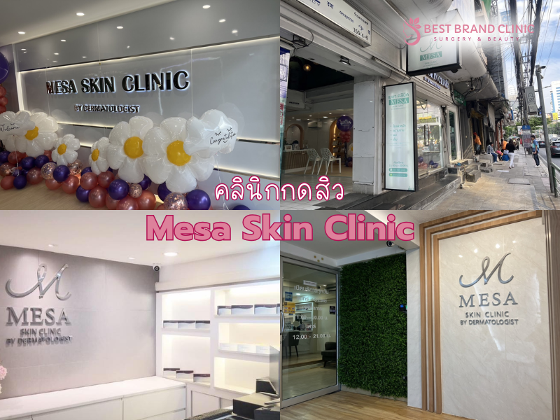 คลินิกกดสิวทรีทเม้นท์ ที่ดีที่สุด Mesa Skin Clinic