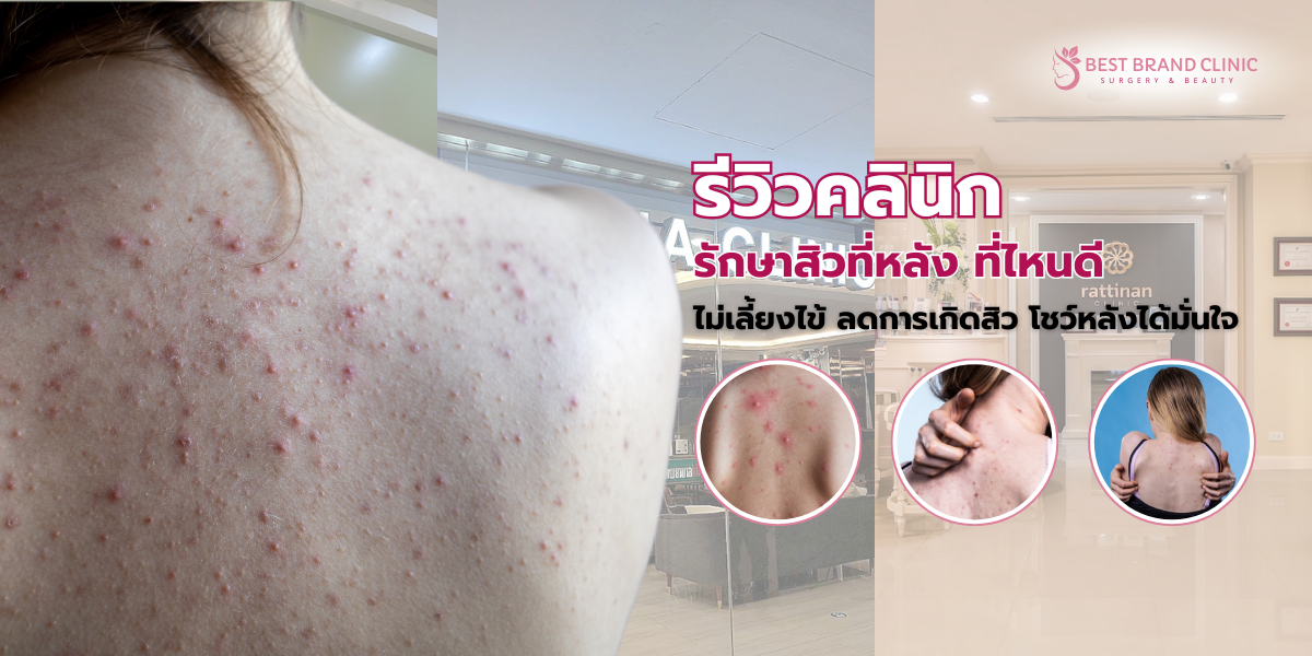 รักษาสิวที่หลัง ที่ไหนดี