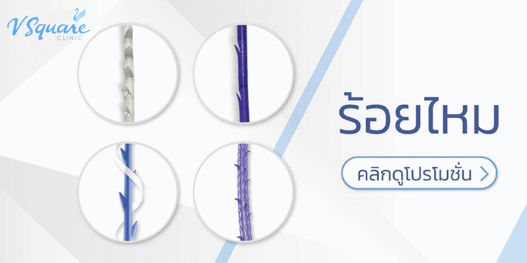 โปรร้อยไหมจมูก ที่ V Square Clinic
