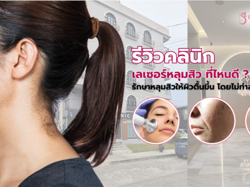 เลเซอร์หลุมสิว ที่ไหนดี