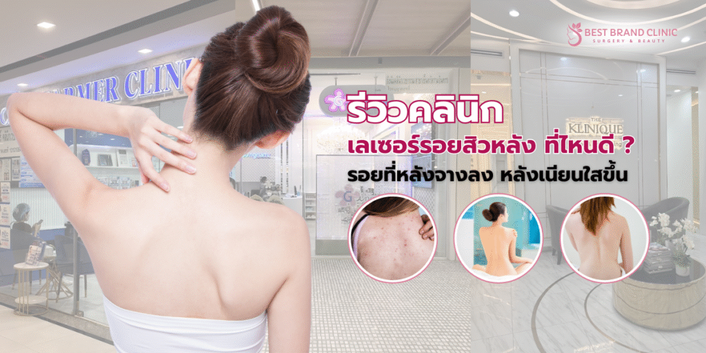 เลเซอร์รอยสิวที่หลัง ที่ไหนดี