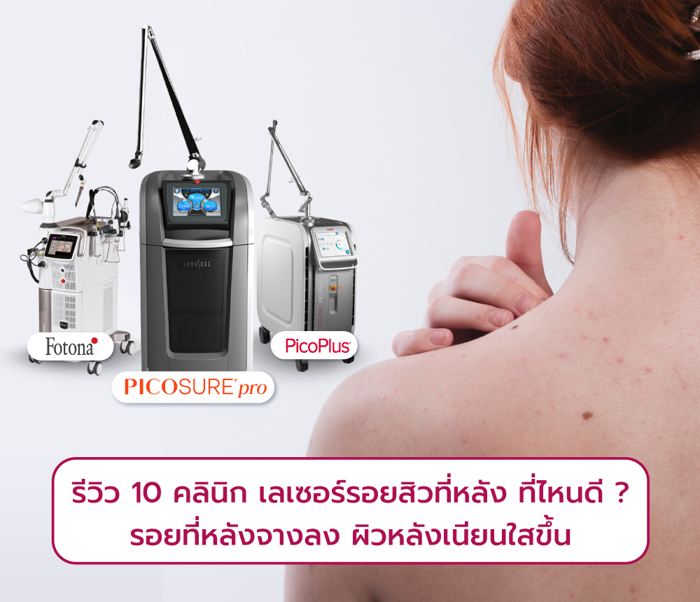 เลเซอร์รอยสิวที่หลัง ที่ไหนดี