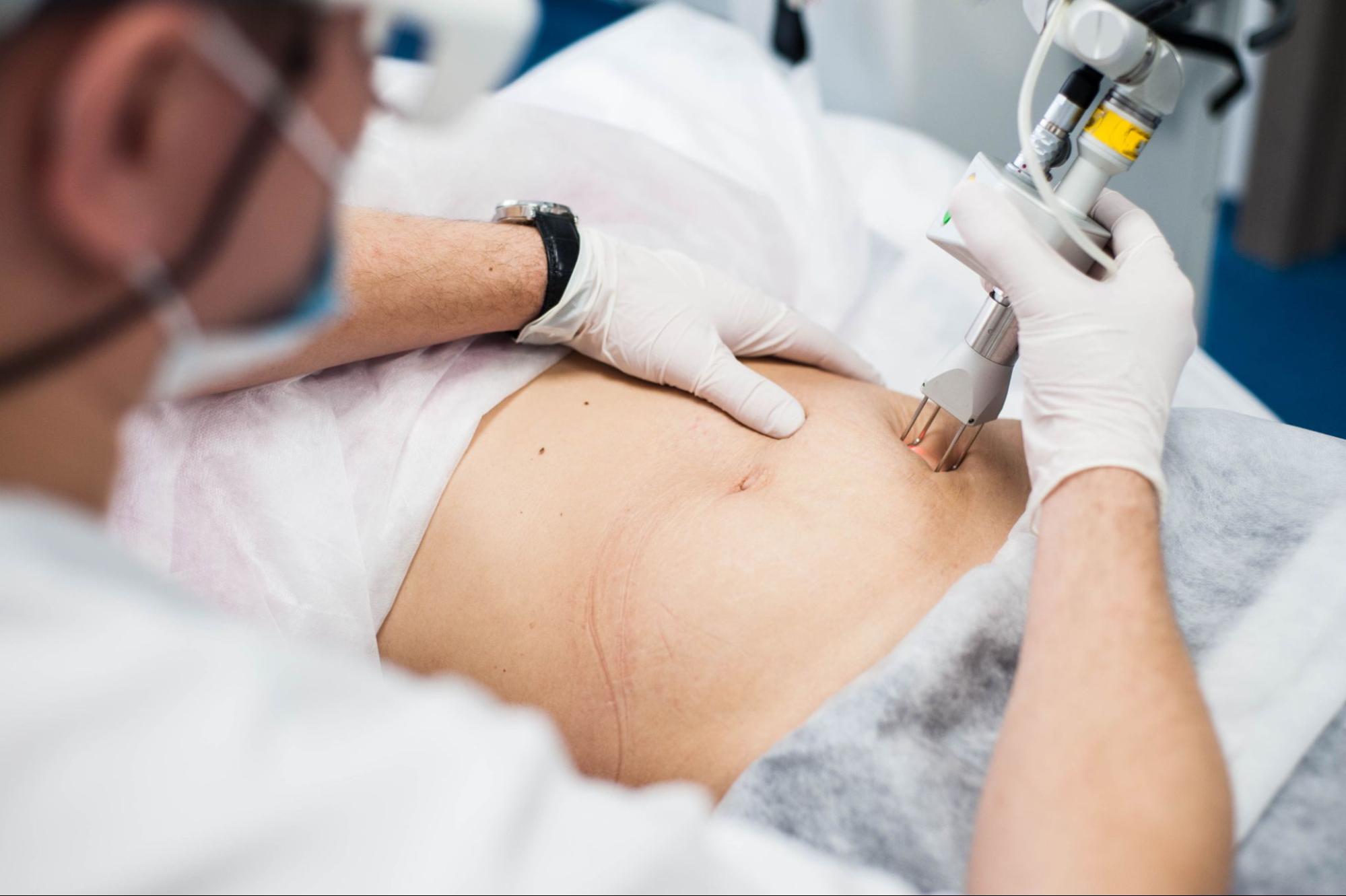 Laser รอยแตกลาย โดยแพทย์