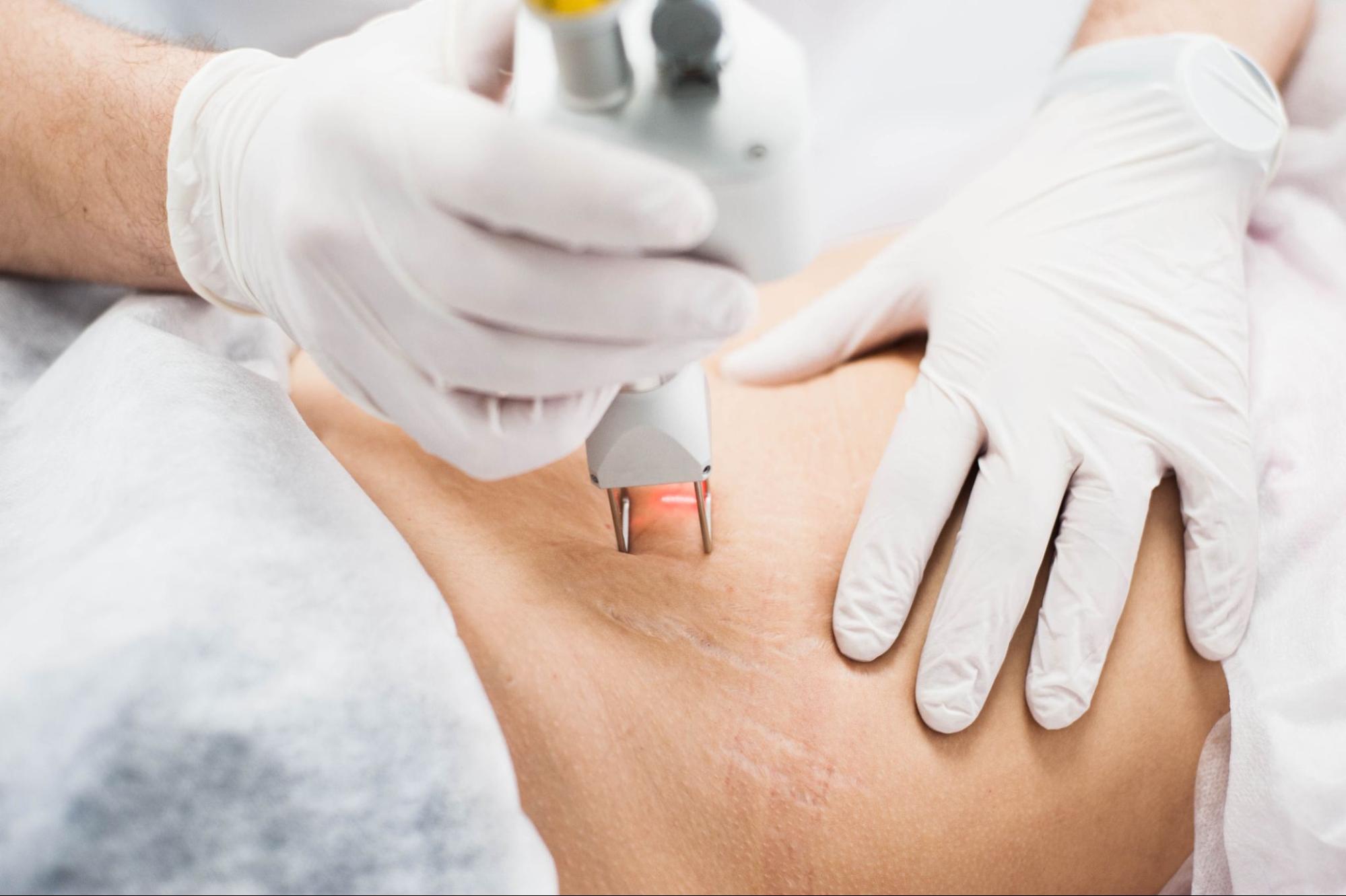 เลเซอร์รอยแตกลาย