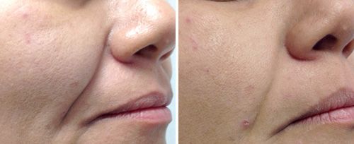 ผลลัพธ์ Fotona Laser
