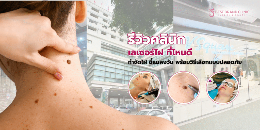 เลเซอร์ไฝ ที่ไหนดี
