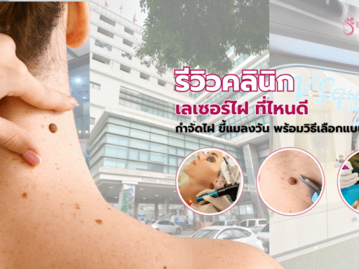 เลเซอร์ไฝ ที่ไหนดี