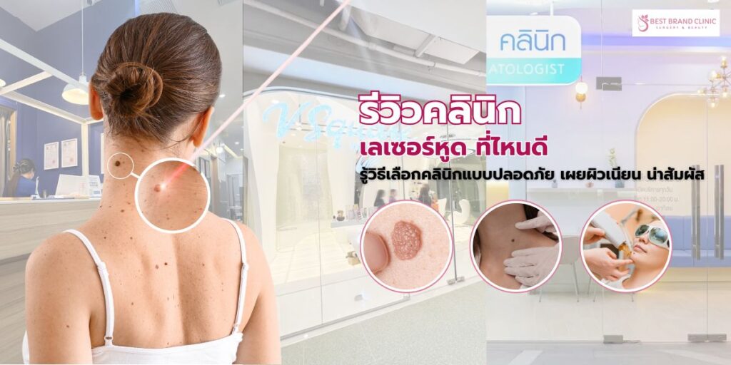 เลเซอร์หูด ที่ไหนดี