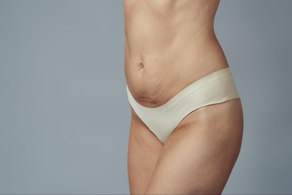 Sculptra Body เหมาะกับใคร _