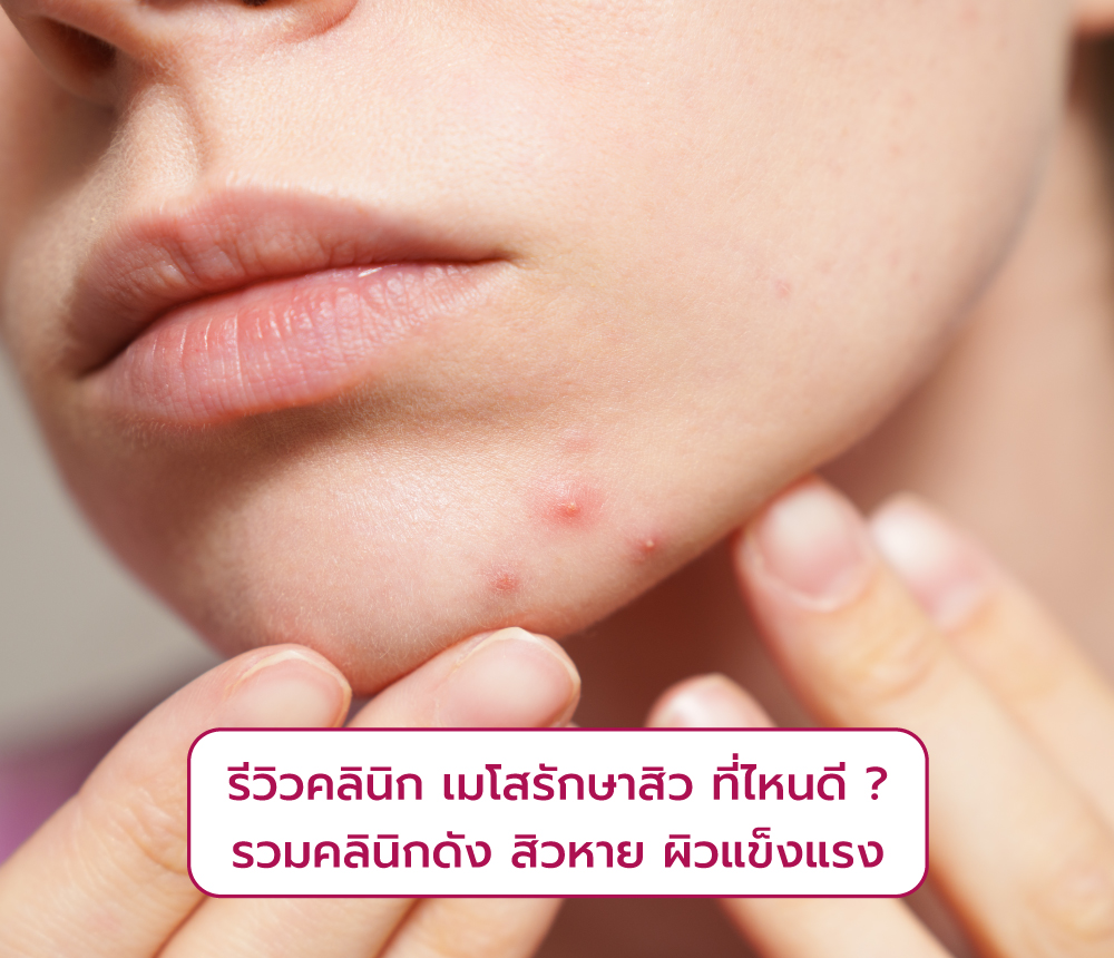 เมโสรักษาสิว ที่ไหนดี