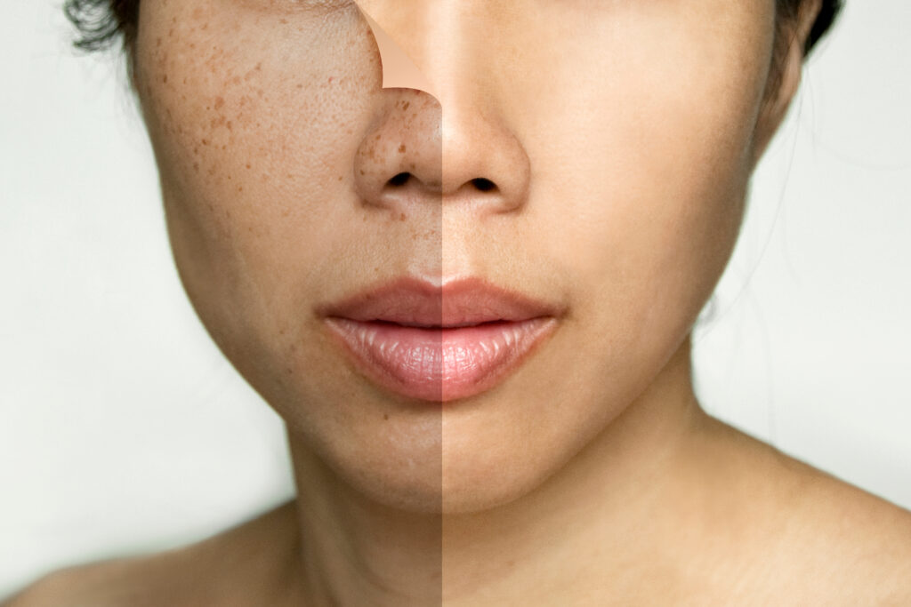 Rejuvenation Laser เหมาะกับใคร