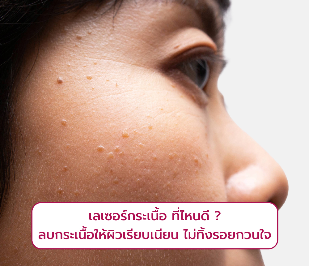 เลเซอร์กระเนื้อที่ไหนดี