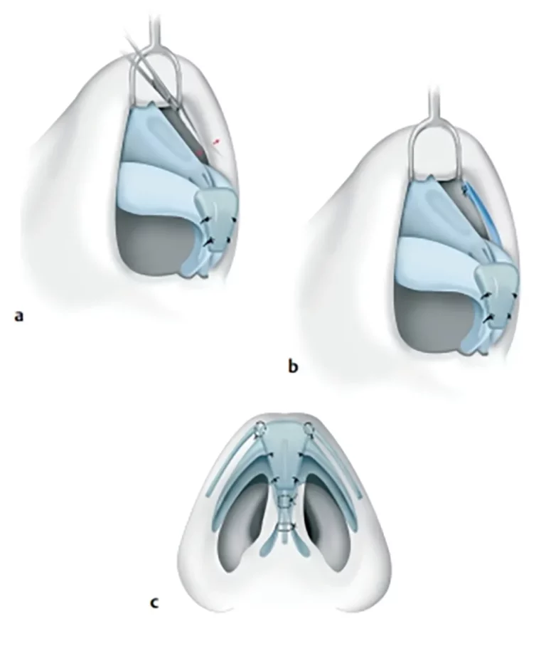 เสริมจมูกแบบโอเพ่น คืออะไร