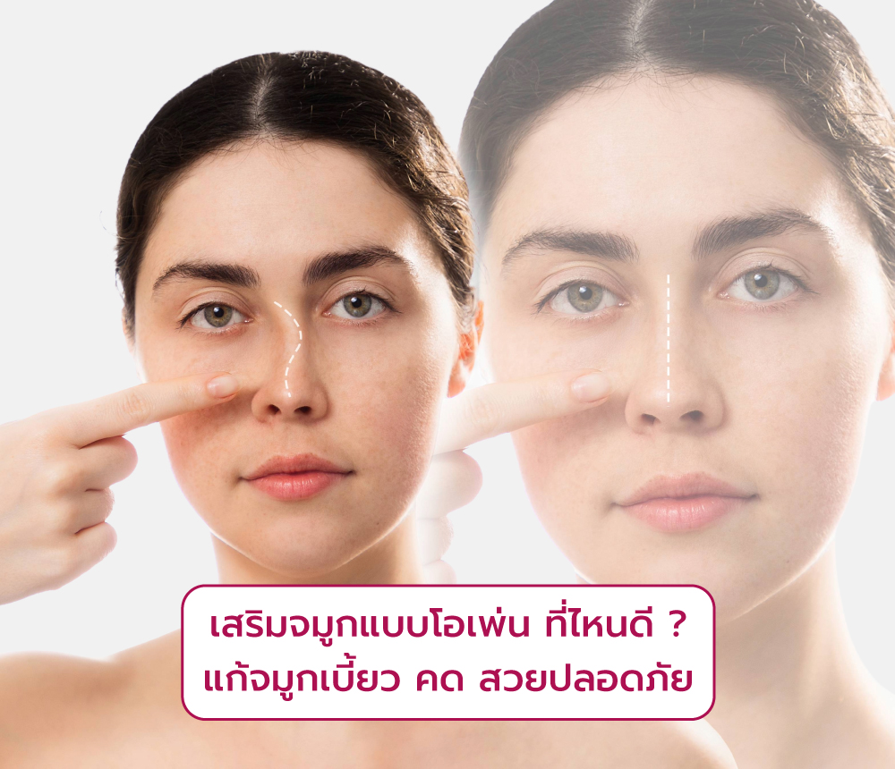 เสริมจมูกแบบโอเพ่นที่ไหนดี