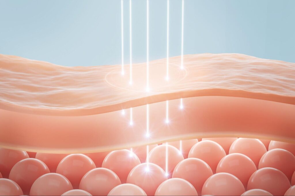 หลักการทำงานของเลเซอร์ผิวเรียบเนียน