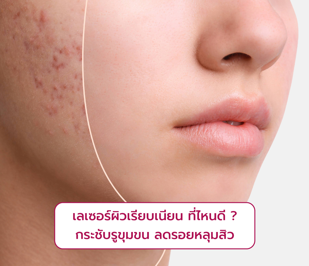 เลเซอร์ผิวเรียบเนียน ที่ไหนดี