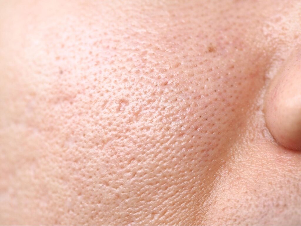 เลเซอร์ผิวเรียบเนียน เหมาะกับปัญหาผิว