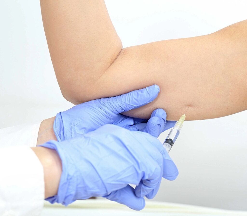 โบท็อกลดกล้ามแขน