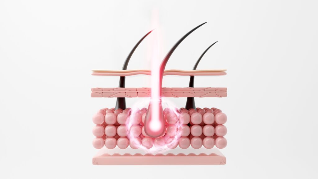 พลังงานเลเซอร์กำจัดขนหลัง