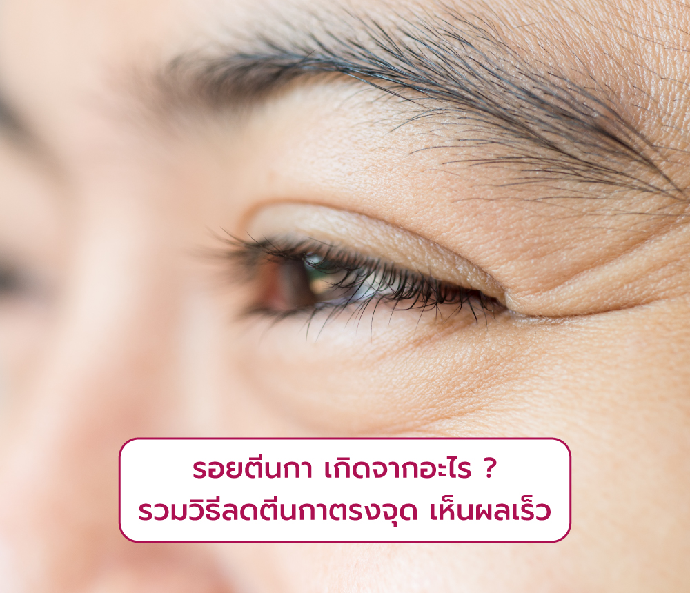 รอยตีนกา เกิดจากอะไร