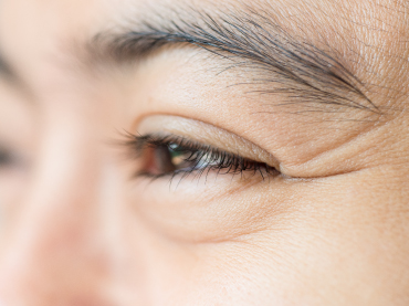 รอยตีนกา เกิดจากอะไร 370x277