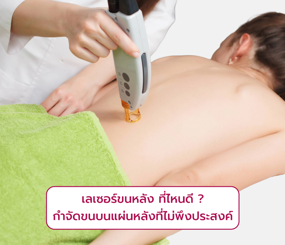 เลเซอร์ขนหลัง ที่ไหนดี