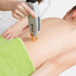 เลเซอร์ขนหลังที่ไหนดี370x277