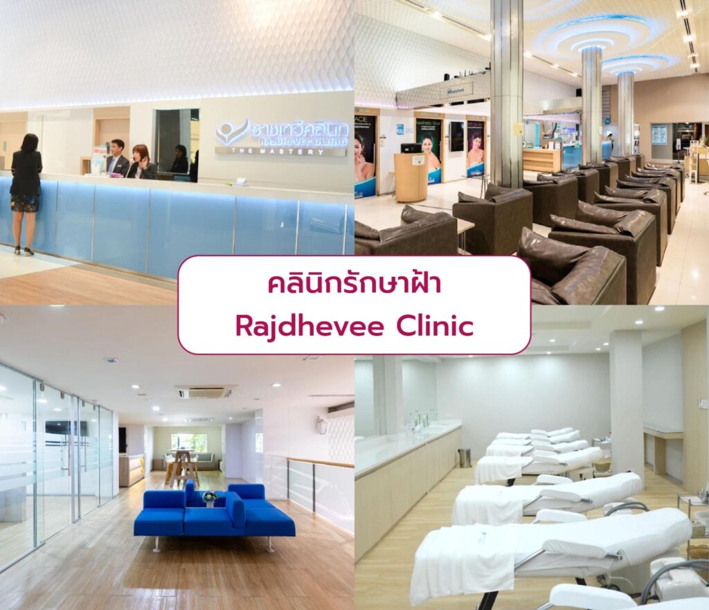 Best clinic for Melasma treatment Rajdhevee Clinic