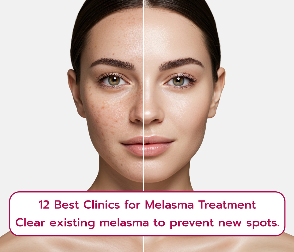 Best clinic for Melasma treatment