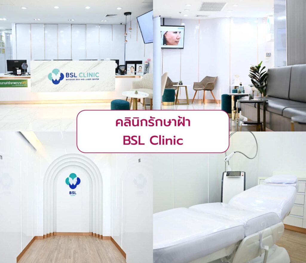Best clinic for melasma treatment BSL Clinic