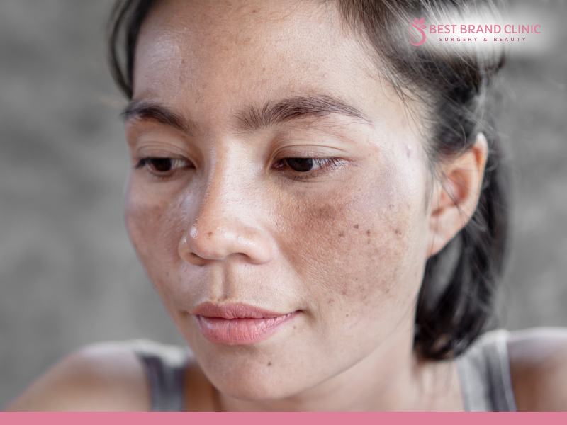 Melasma treatment by a doctor