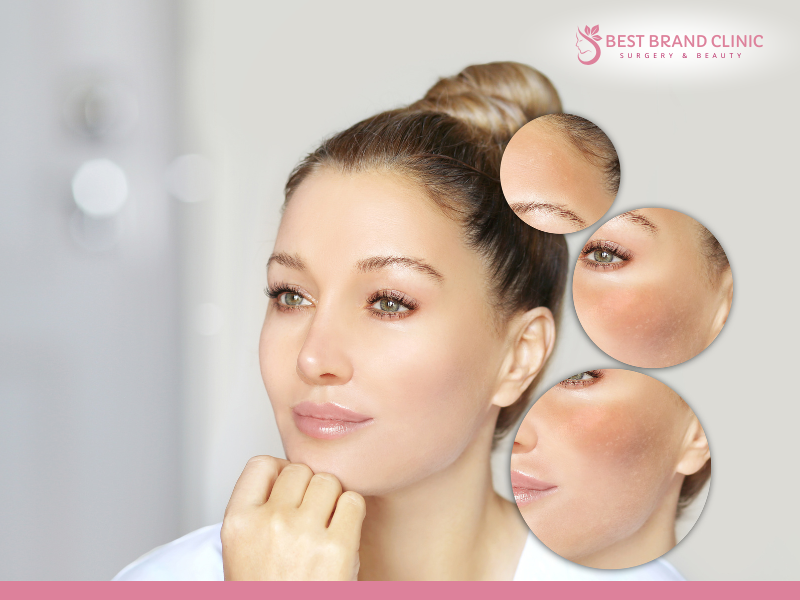 Why choosing the right melasma clinic matters