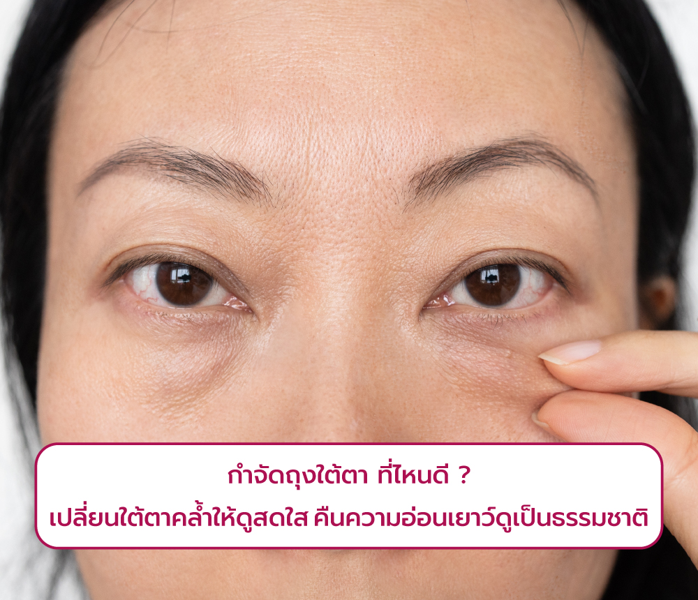 กําจัดถุงใต้ตา-ที่ไหนดี-1000x860