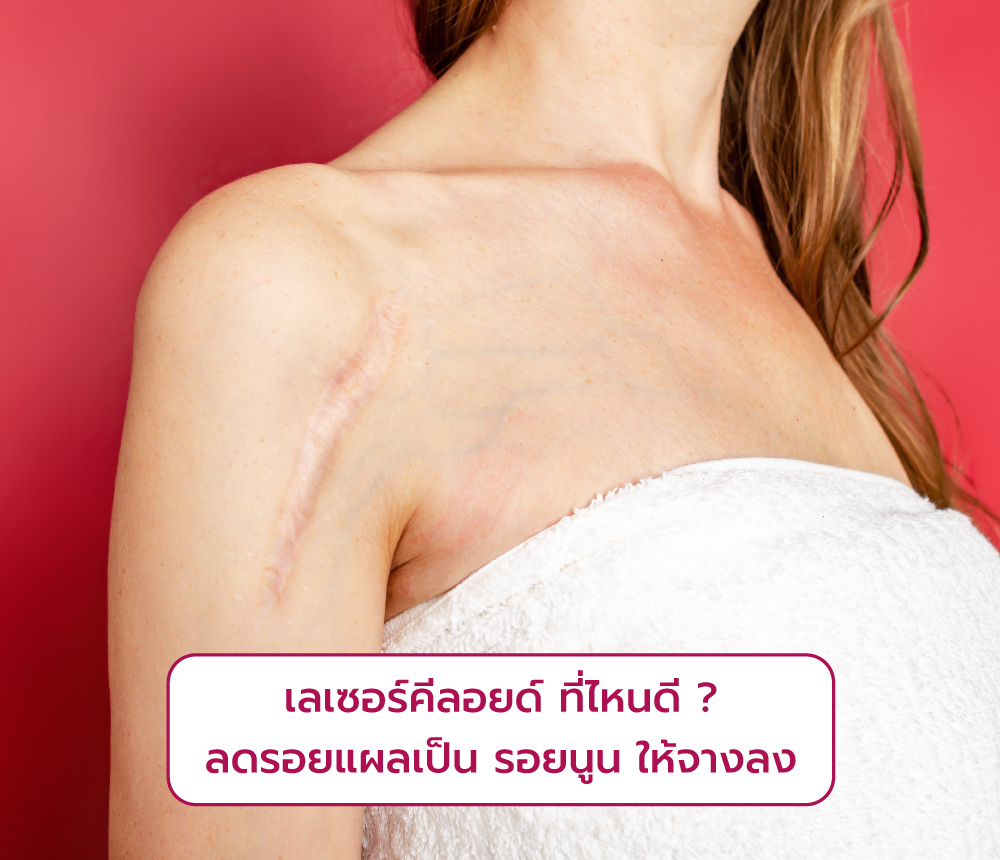 เลเซอร์คีลอยด์ ที่ไหนดี