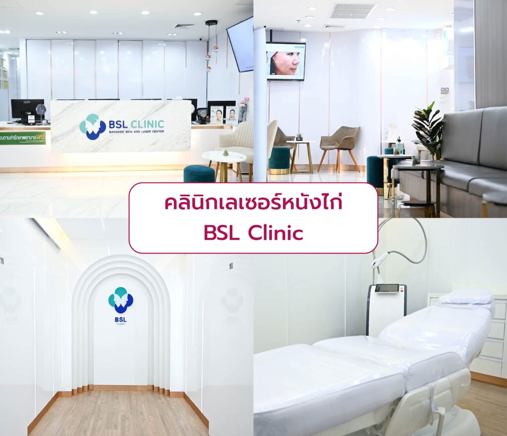 เลเซอร์รักษาตุ่มหนังไก่ ที่ไหนดี BSL Clinic