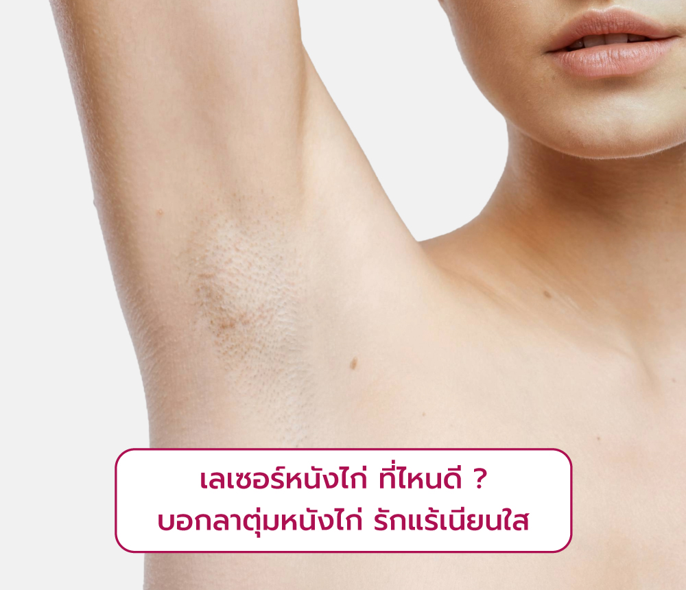 เลเซอร์หนังไก่ ที่ไหนดี
