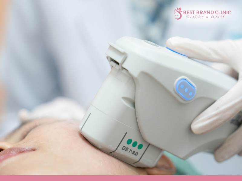 Areas that can be treated with Ultherapy Prime